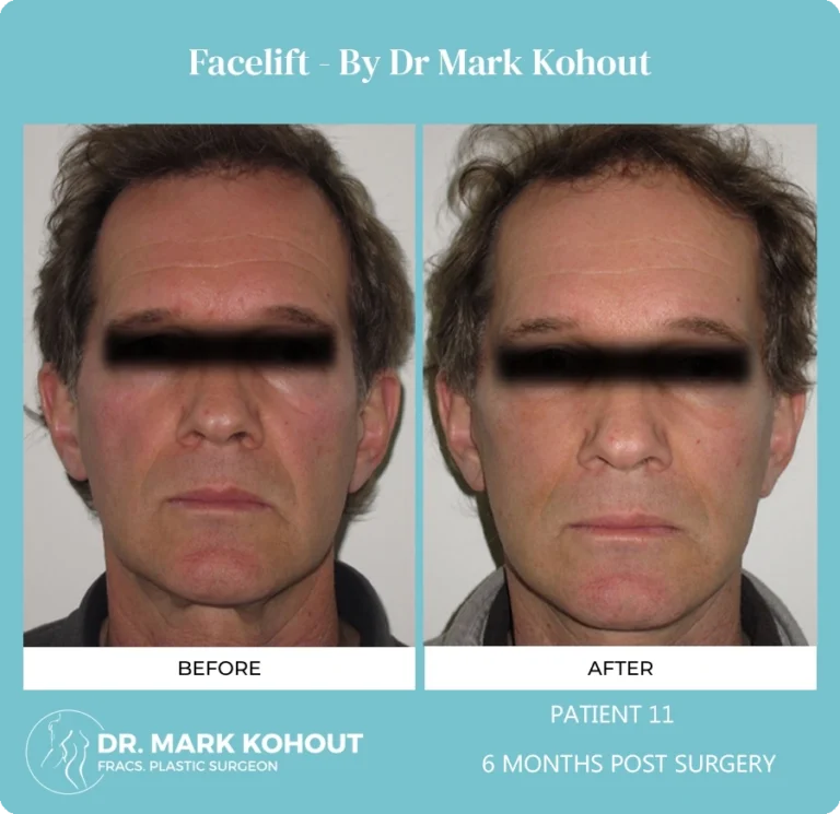Patient 11 Facelift Front - Dr Mark Kohout