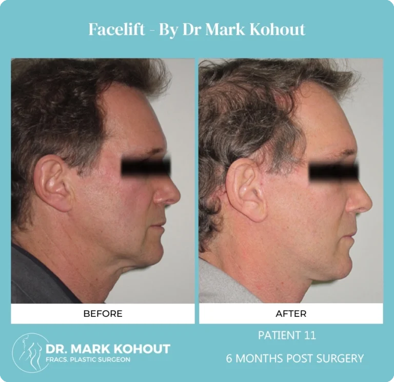 Patient 11 Facelift Side - Dr Mark Kohout
