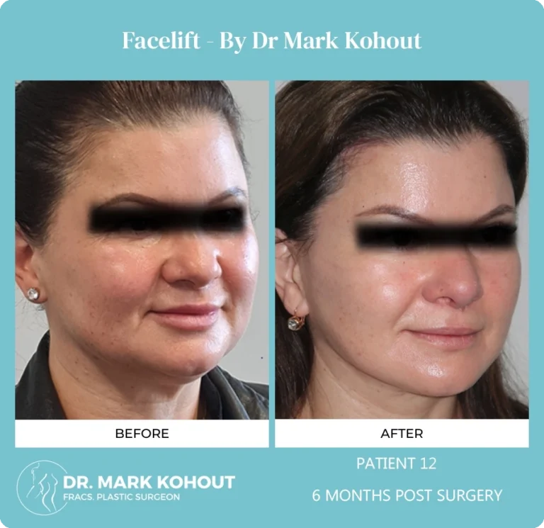 Patient 12 Facelift 45 - Dr Mark Kohout
