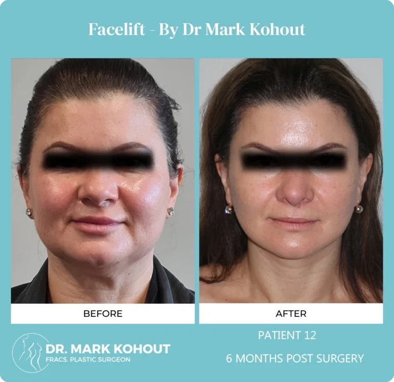 Patient 12 Facelift Front - Dr Mark Kohout