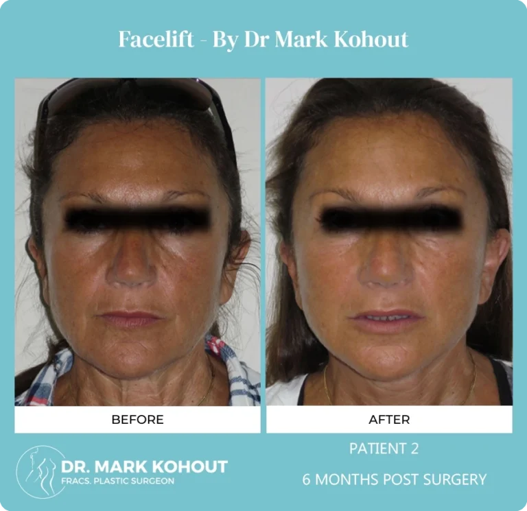 Patient 2 Facelift Front - Dr Mark Kohout