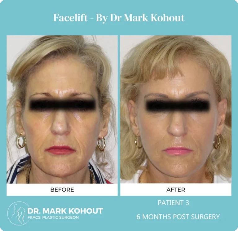 Patient 3 Facelift Front - Dr Mark Kohout