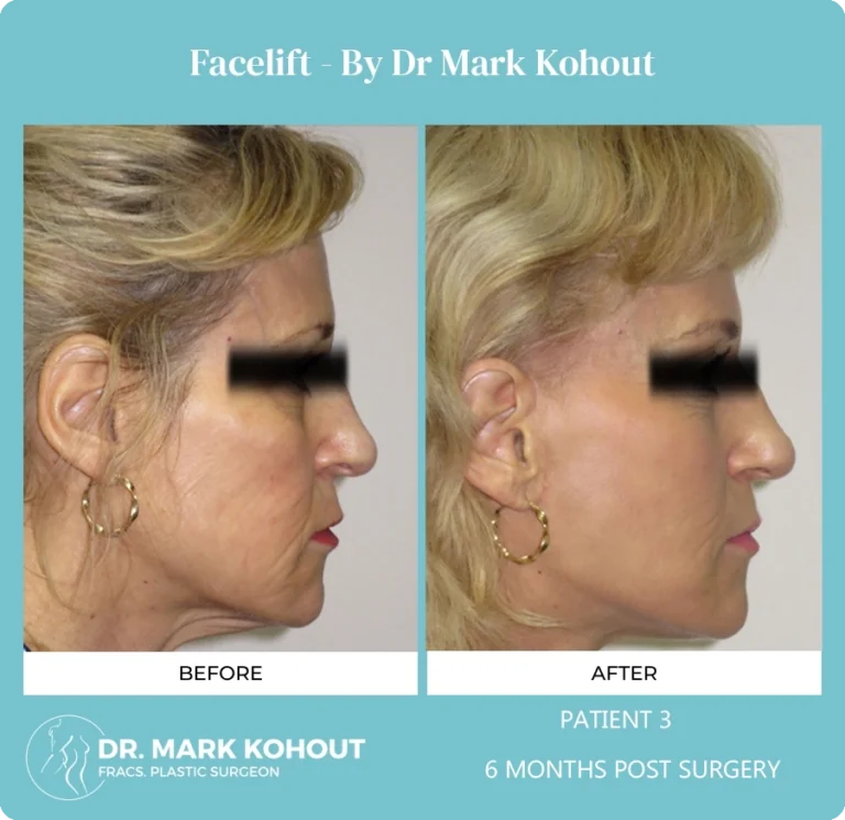 Patient 3 Facelift Side - Dr Mark Kohout