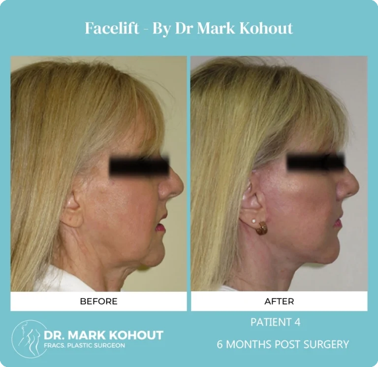 Patient 4 Facelift Side - Dr Mark Kohout