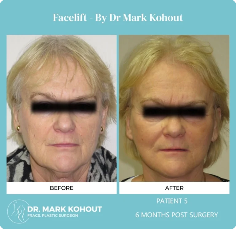 Patient 5 Facelift Front - Dr Mark Kohout