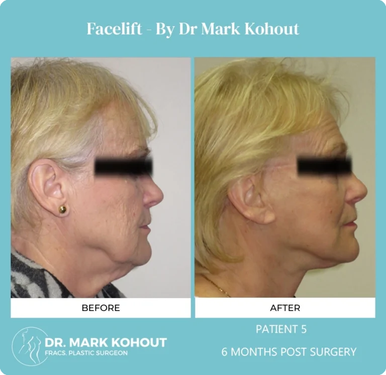 Patient 5 Facelift Side - Dr Mark Kohout