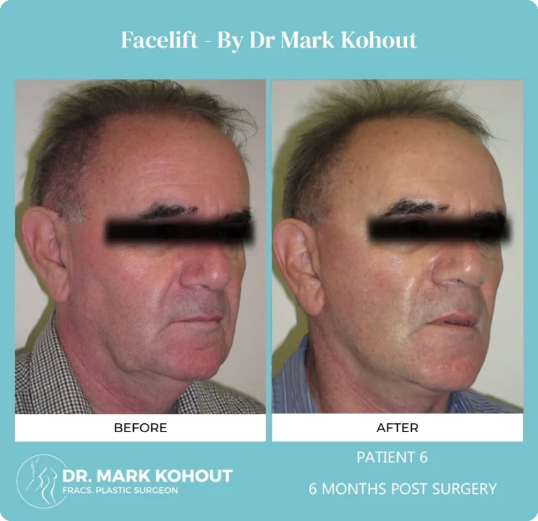 Patient 6 Facelift 45 - Dr Mark Kohout