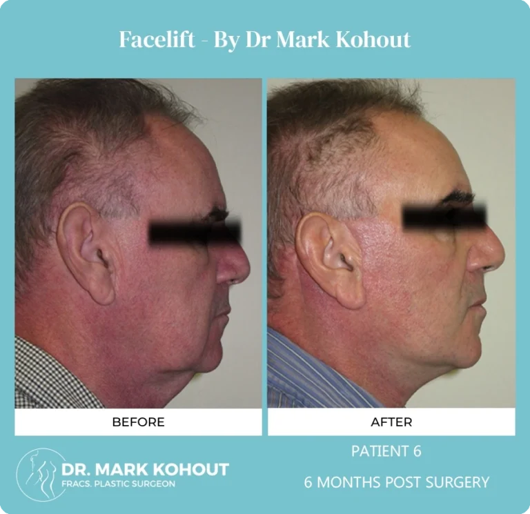 Patient 6 Facelift Side - Dr Mark Kohout