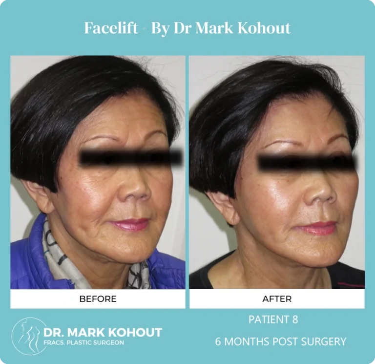 Patient 8 Facelift 45 - Dr Mark Kohout