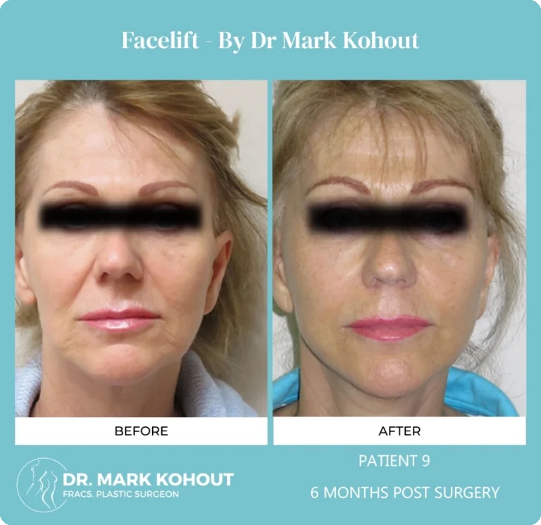 Patient 9 Facelift Front - Dr Mark Kohout