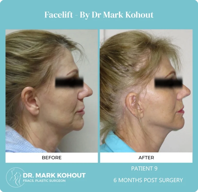 Patient 9 Facelift Side - Dr Mark Kohout
