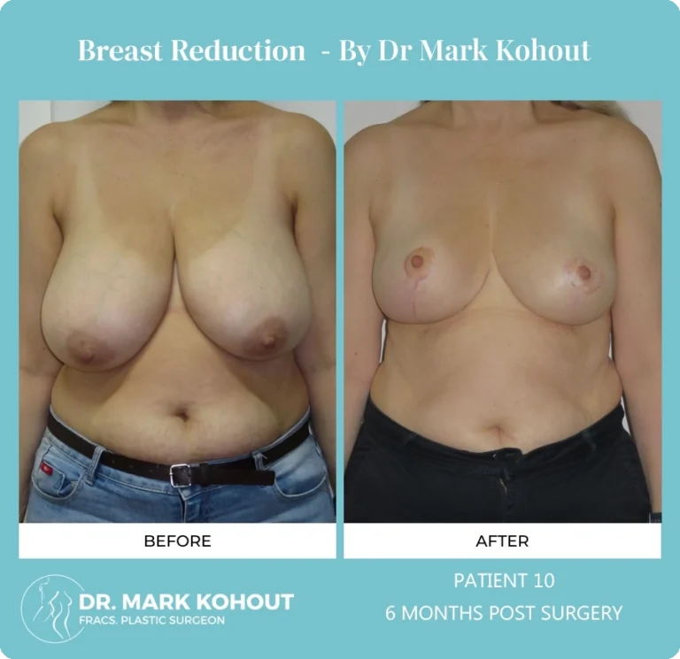 Breast Reduction Patient 10 front