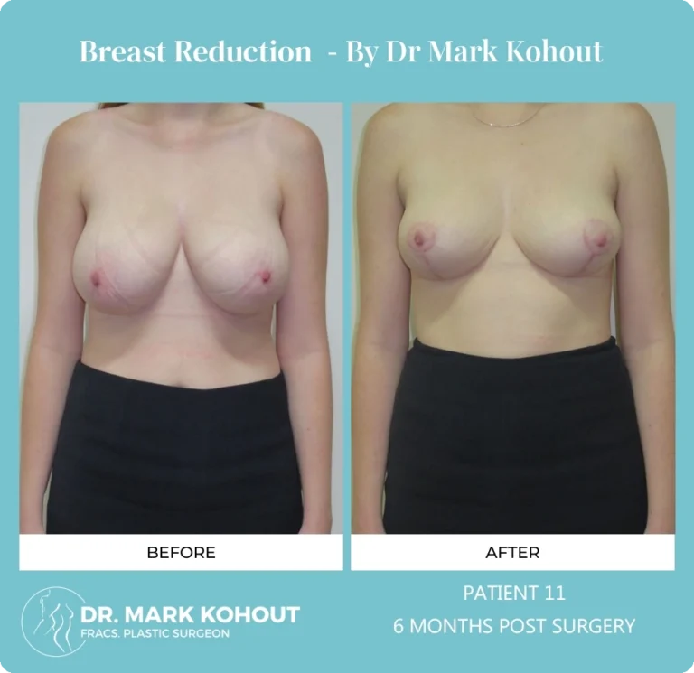 Breast Reduction Patient 11 front