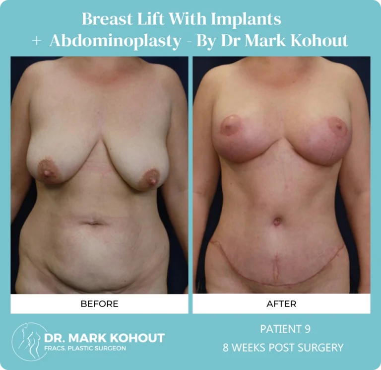 Breastlift with Implant Patient 9 front - Dr Mark Kohout